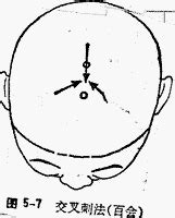 刺血術|醫砭 » 中華針灸 » 刺血法簡史